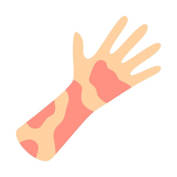 Redness in Skin