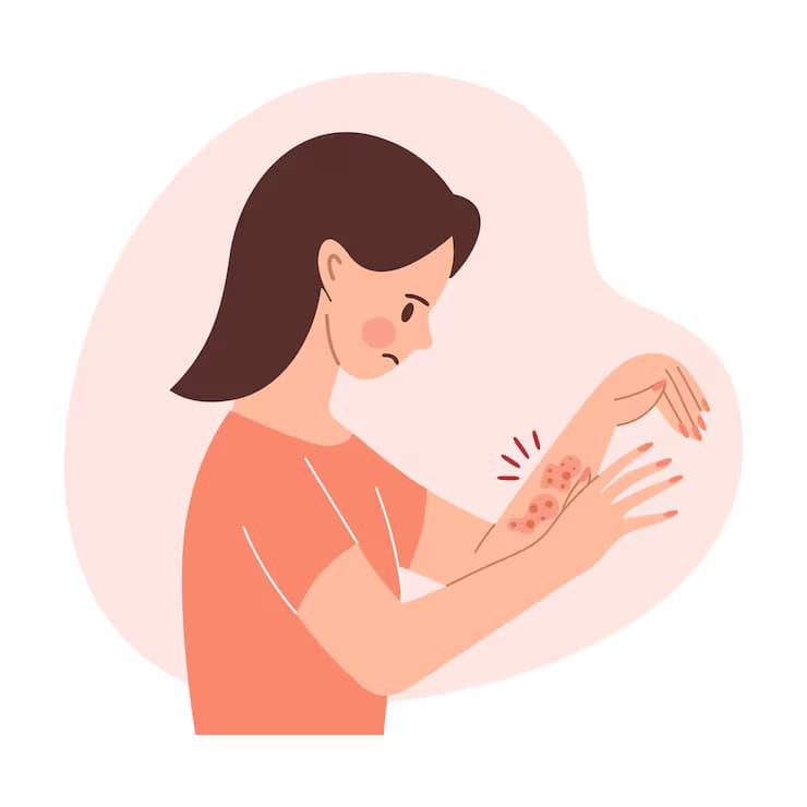 Photoallergic Contact Dermatitis