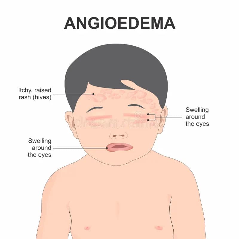 Angioedema