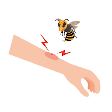 Insect Stings