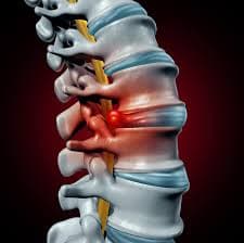 Herniated/Bulging Discs