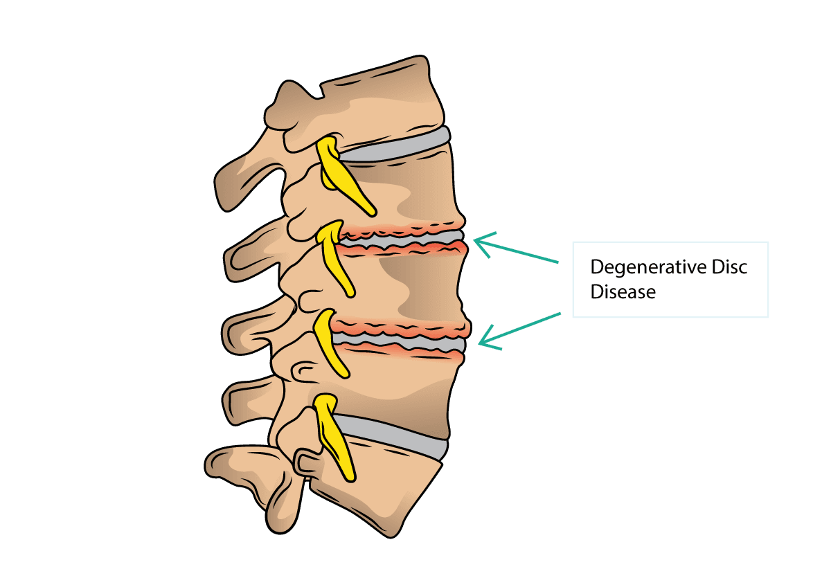 Degenerative Disc Disease