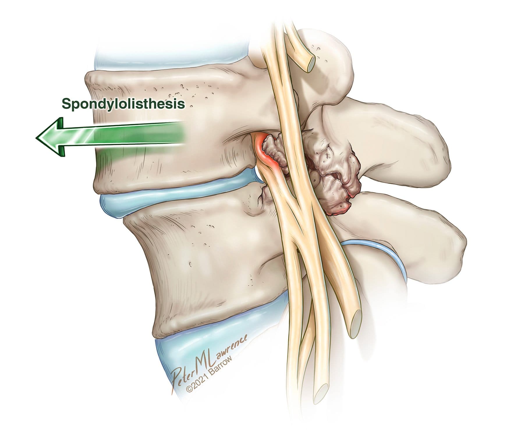 Spondylolisthesis