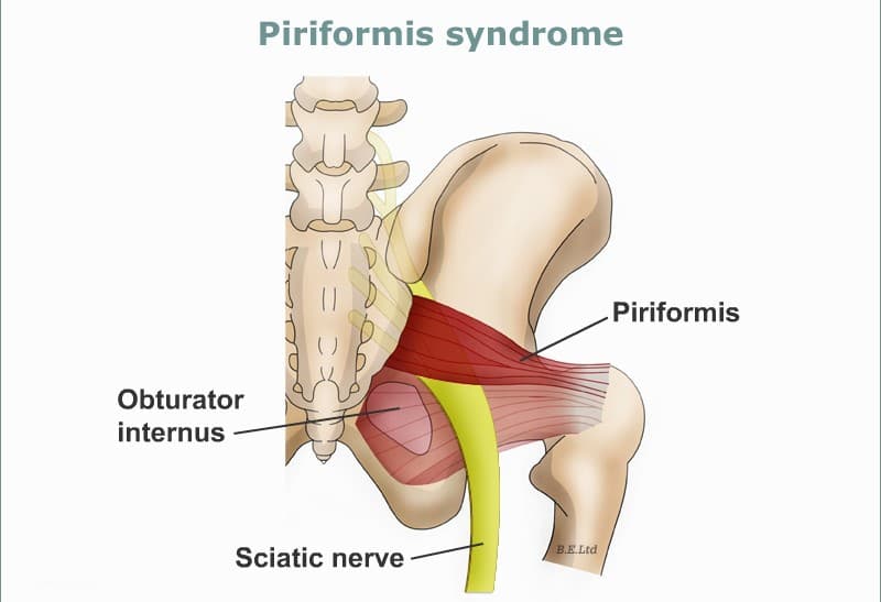 Piriformis Syndrome