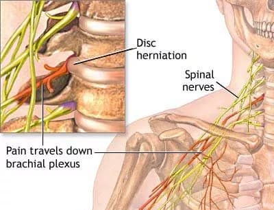 Compressed Nerves