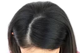Hair Part Widening
