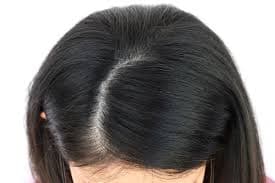 Hair Part Widening