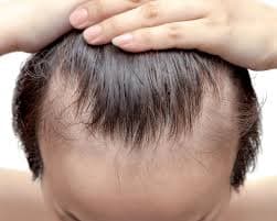 Receding Hairline