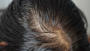 Oily Scalp