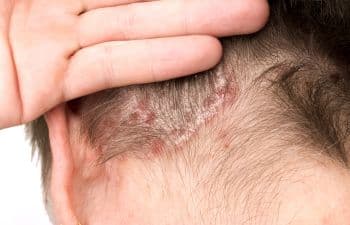 Scalp Irritation