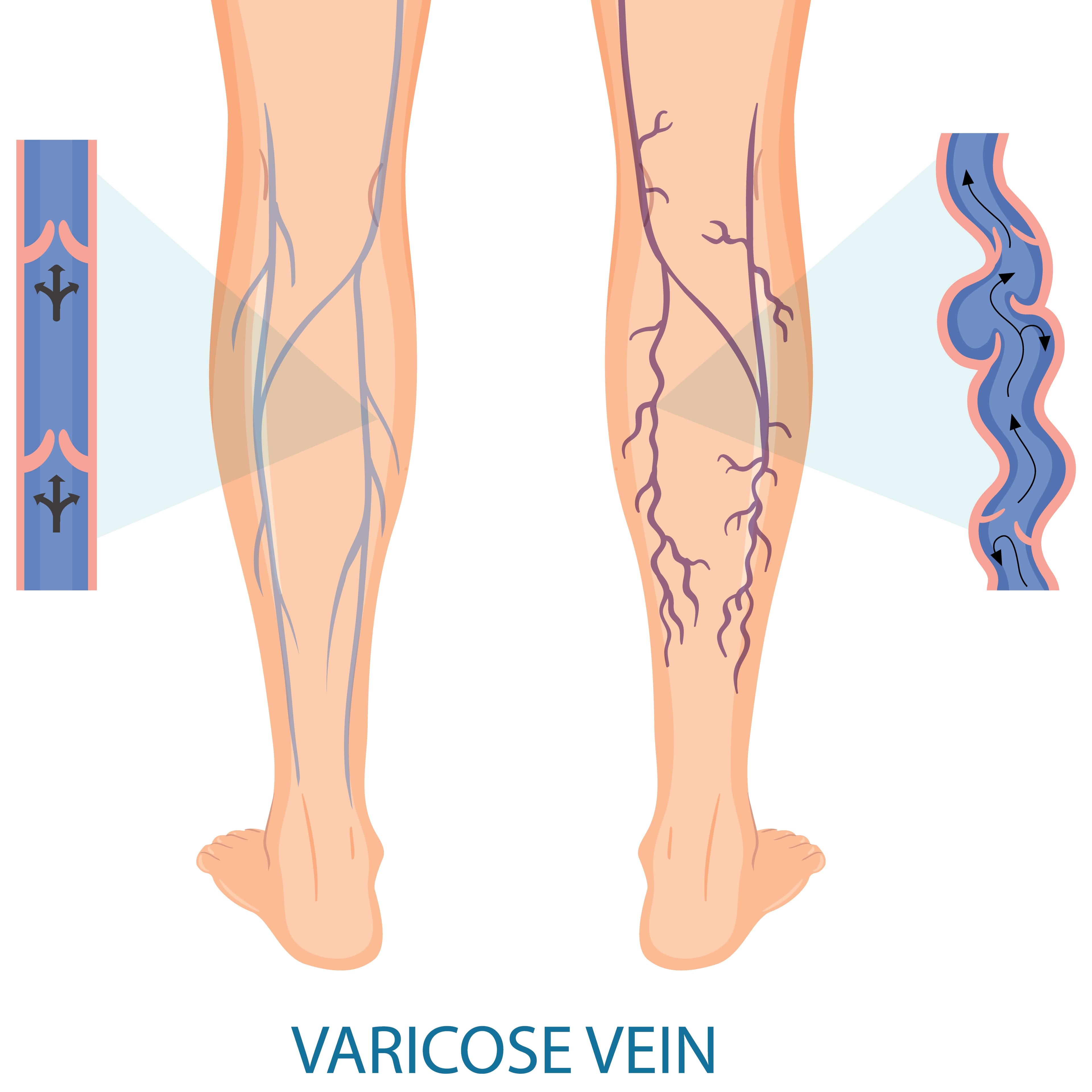 Is Varicose Veins Disturbing you?