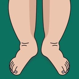 Swelling in Leg