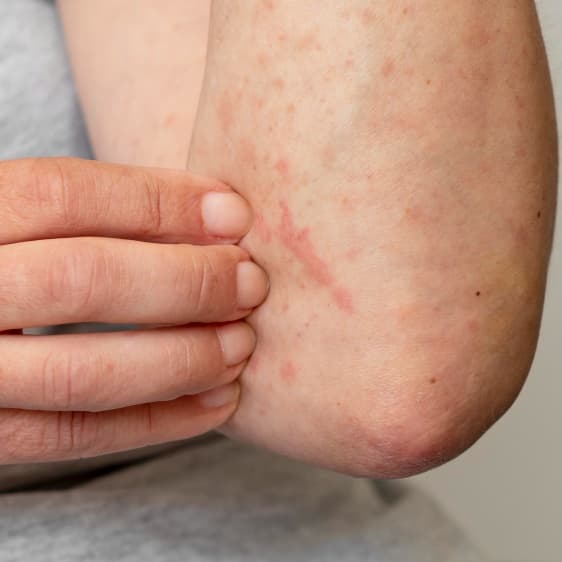 Urticaria (Hives)