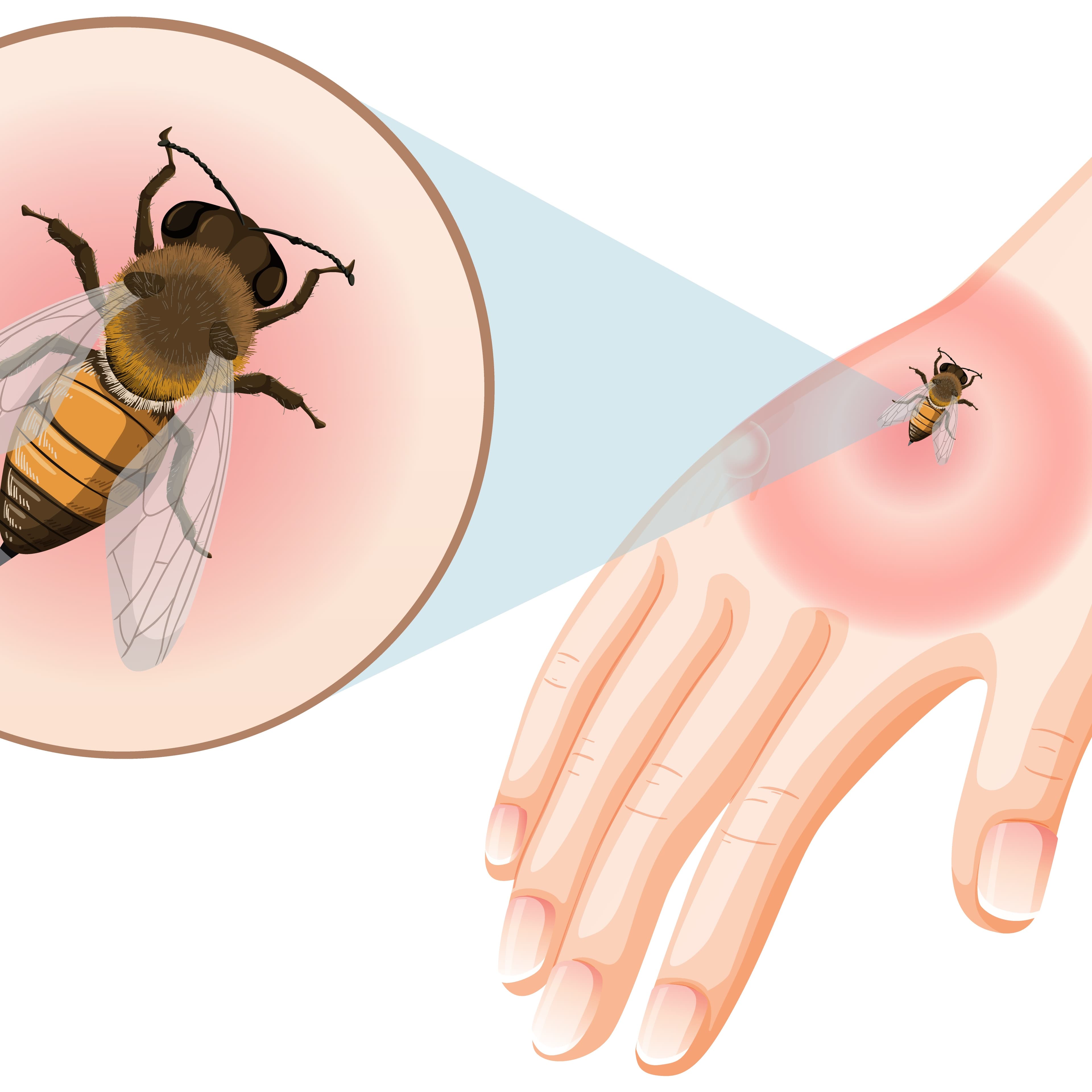 Drug / Insect Allergies