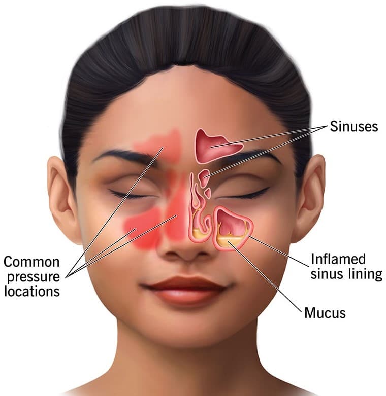 Nasal Causes