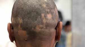 Graying/Patches
