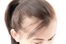Thinning of Hair