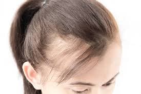 Thinning of Hair
