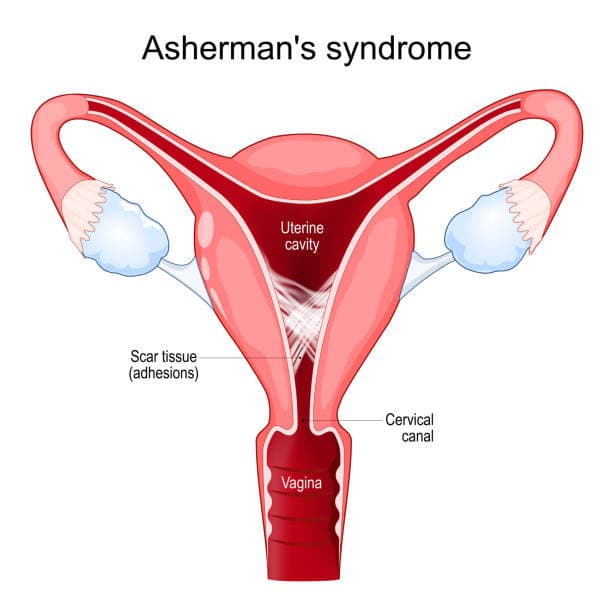 Adhesions or Scarring