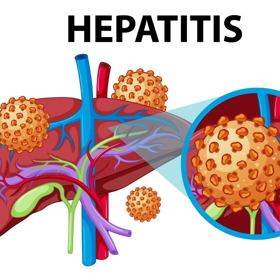 Chronic Viral Hepatitis