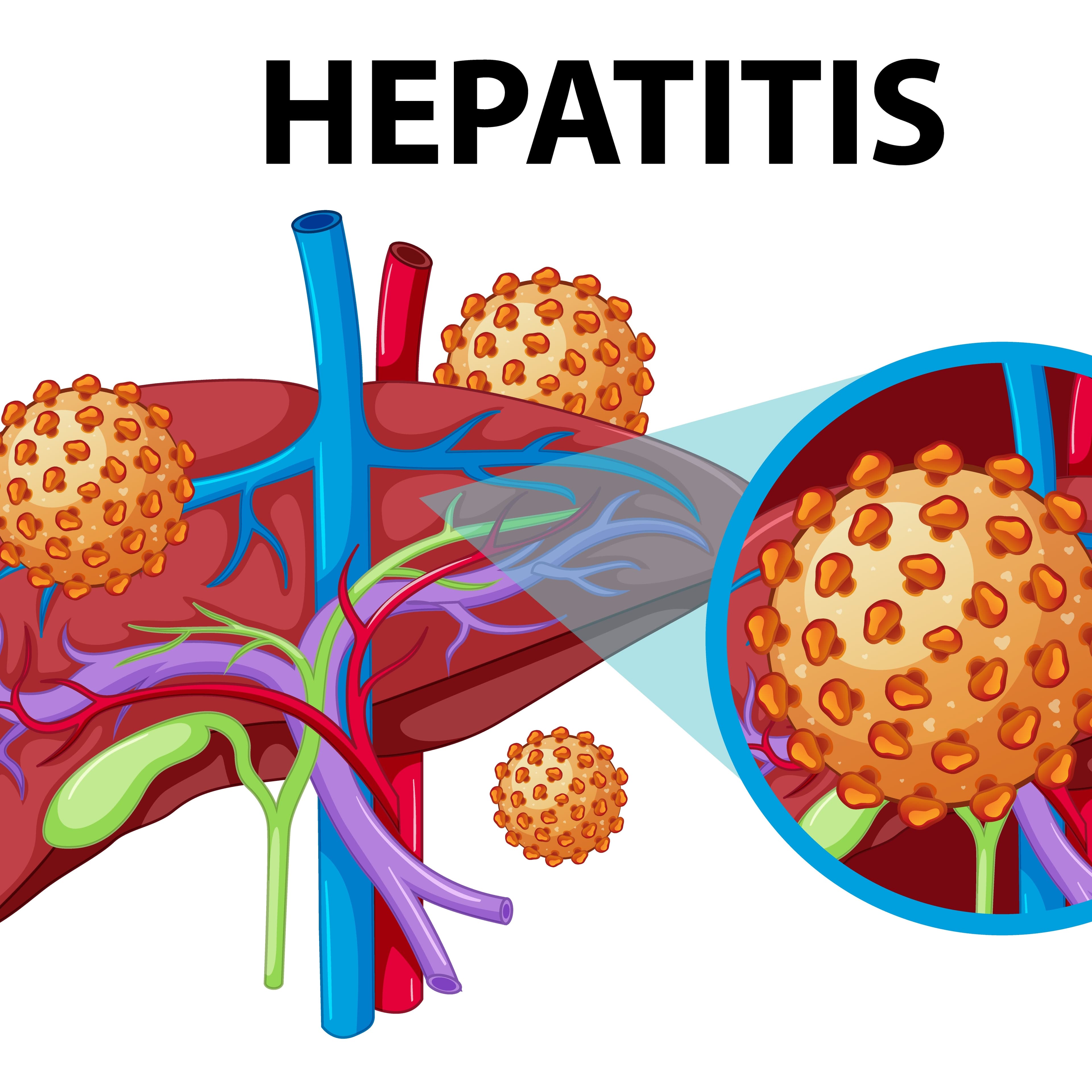 Chronic Viral Hepatitis