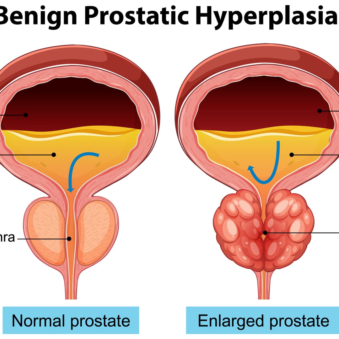 BPH (Benign Prostatic Hyperplasia)