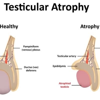 Testicular Atrophy