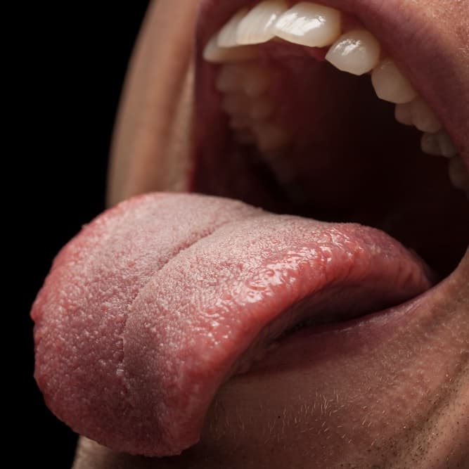 Tongue Coating and Infections