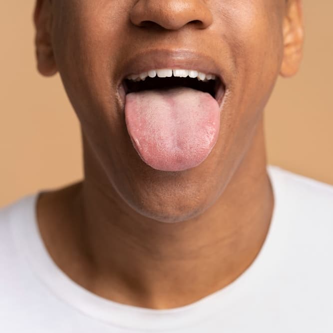 Geographic tongue (benign migratory glossitis)