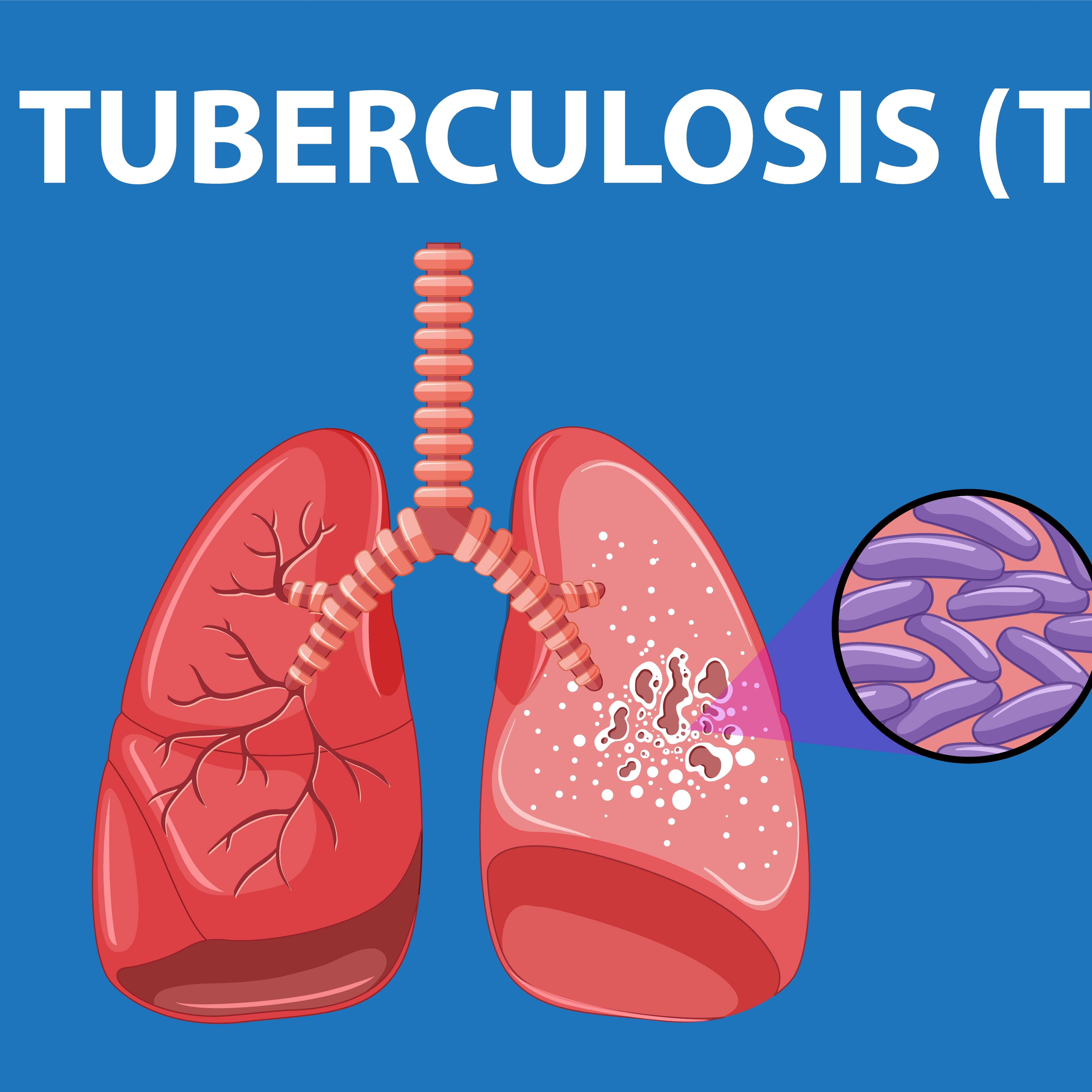 Tuberculosis (TB)