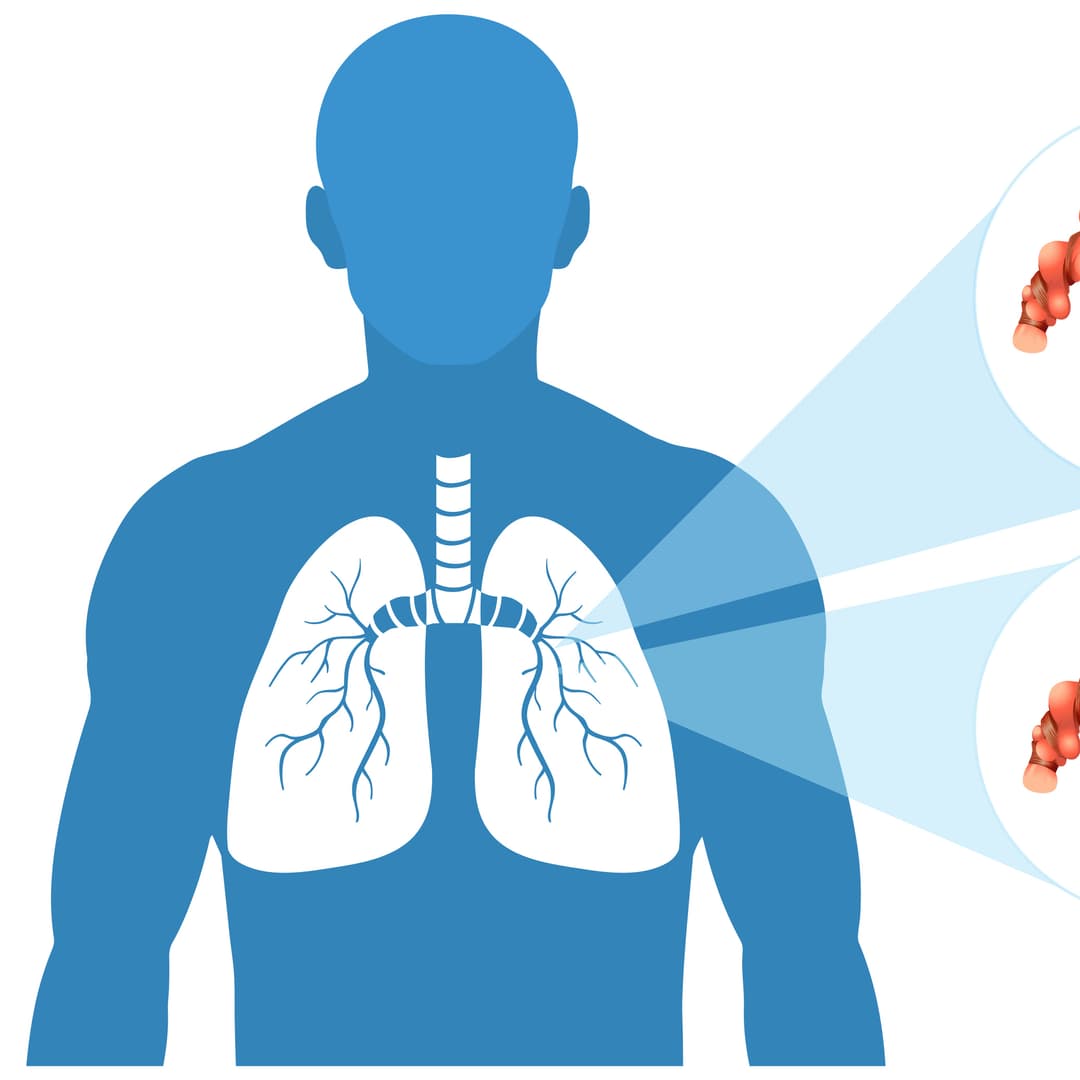 Occupational Lung Diseases