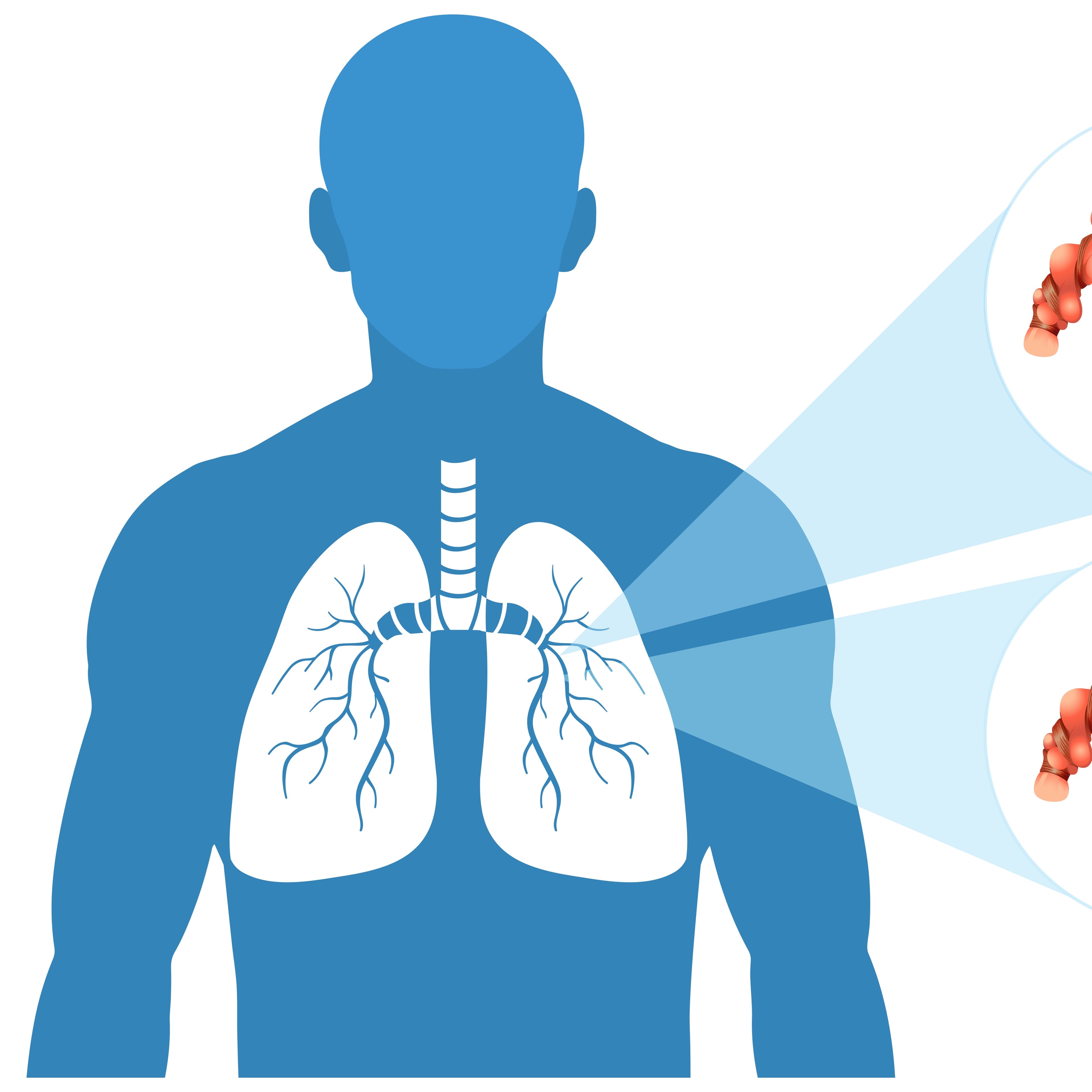 Occupational Lung Diseases