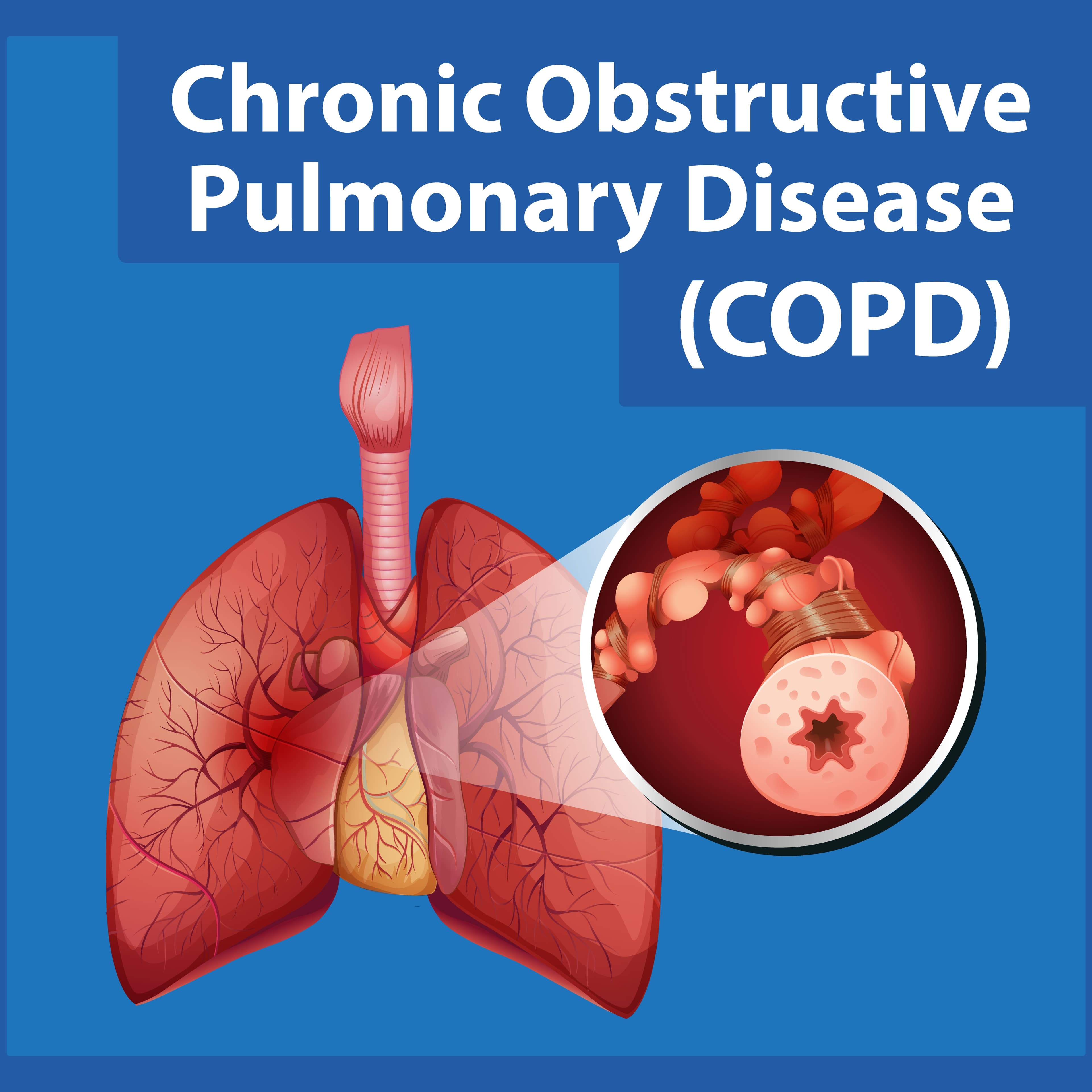 Chronic Obstructive Pulmonary Disease (COPD)