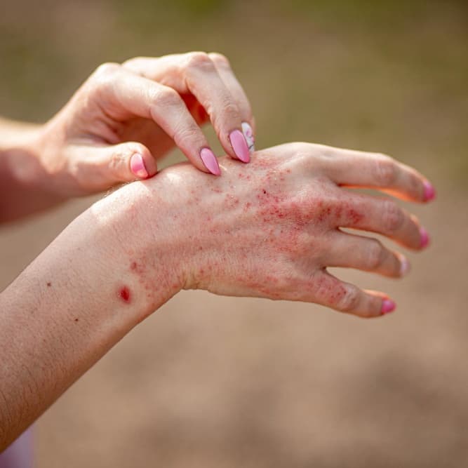 Atopic Dermatitis (Eczema)