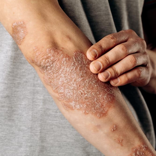 Psoriasis