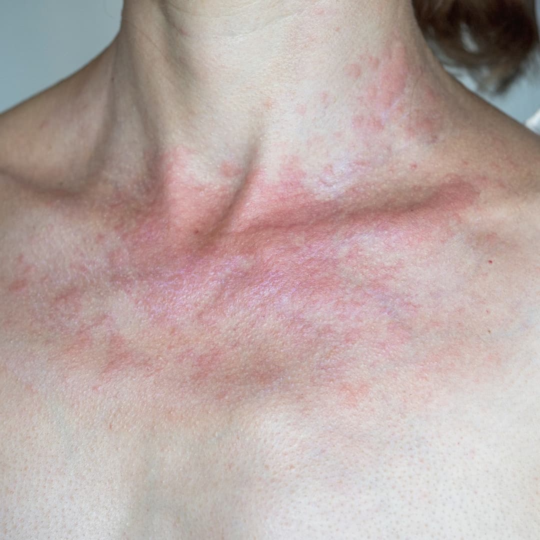 Dermatitis