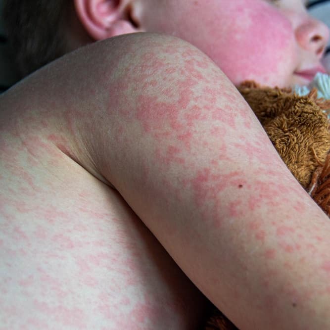 Viral Infections