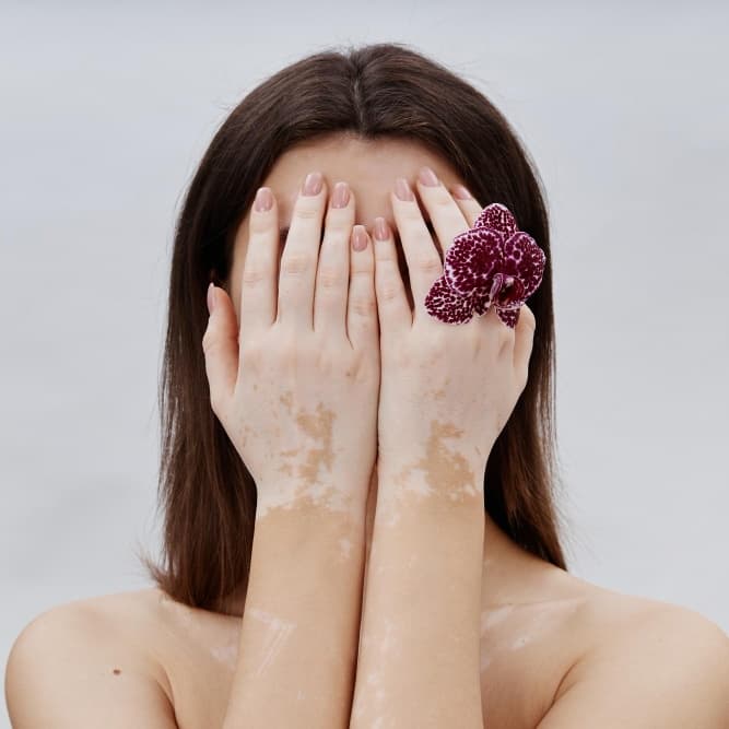 Vitiligo (Leucoderma)