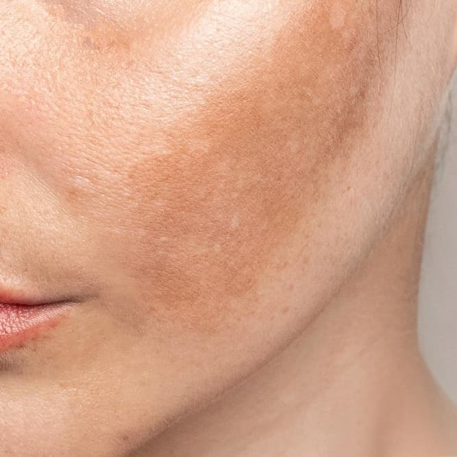 Melasma (Chloasma)