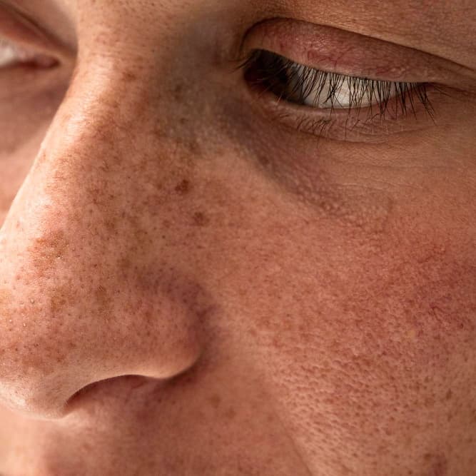 Post-inflammatory Hyperpigmentation