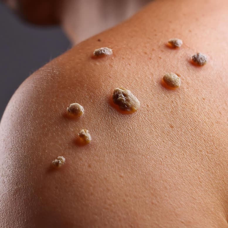 Warts