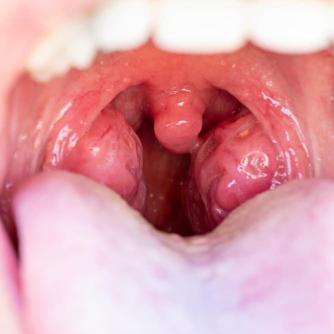 Tonsil Stones