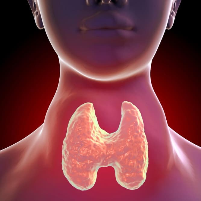 Goiter