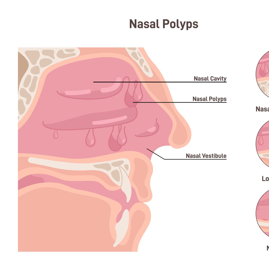 Nasal Polyps
