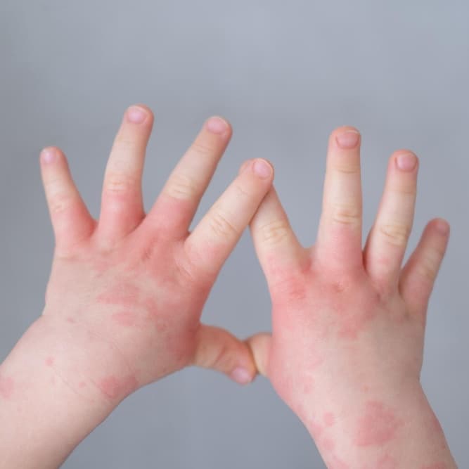 Chronic Skin Complaints
