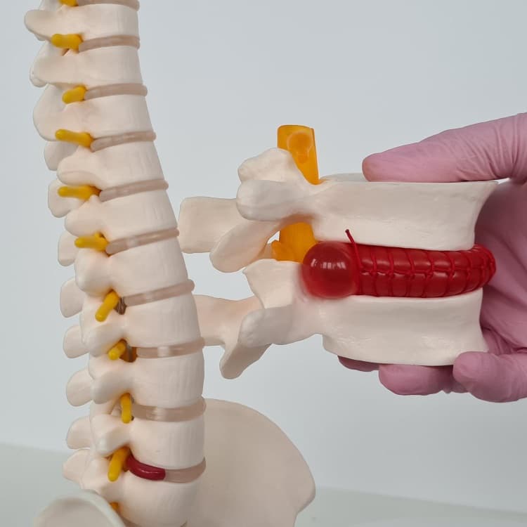 Intervertebral Disc Prolapse (IVDP)