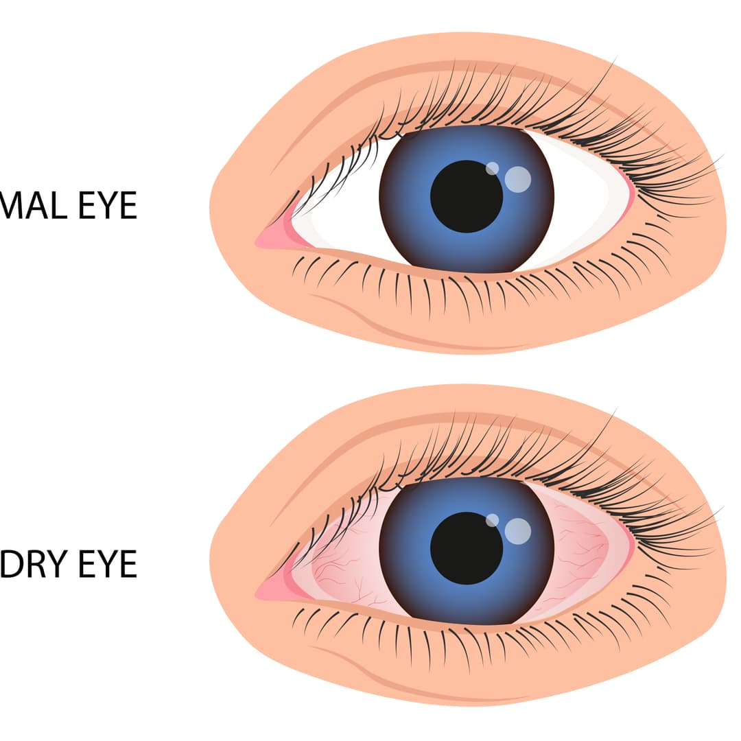 Dry Eye