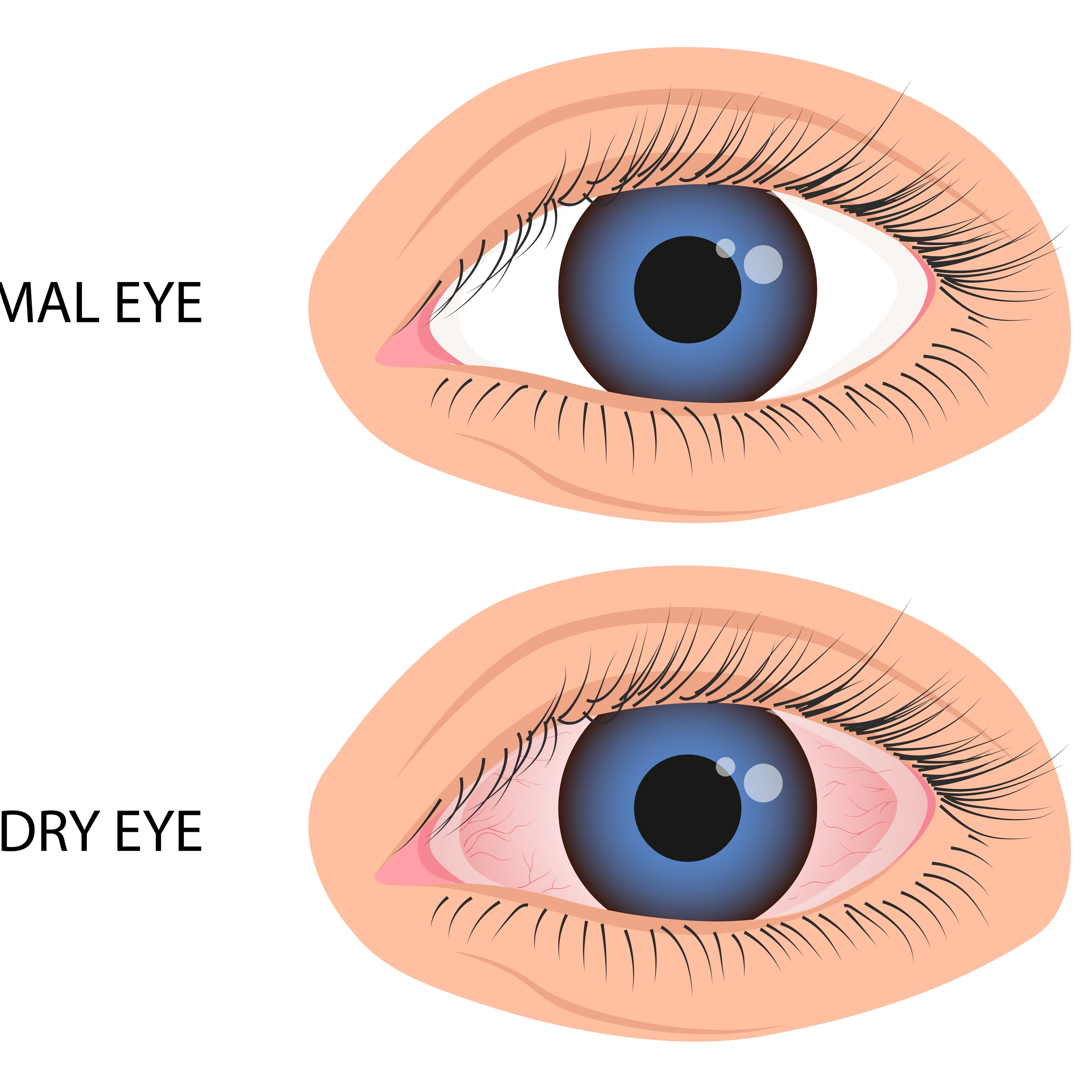 Dry Eye