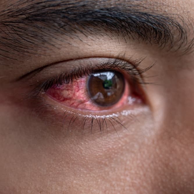 Redness of Eyes