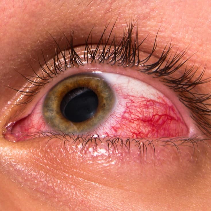 Conjunctivitis